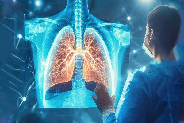 «سل» هنوز در کشور وجود دارد اما کاملاً قابل درمان است